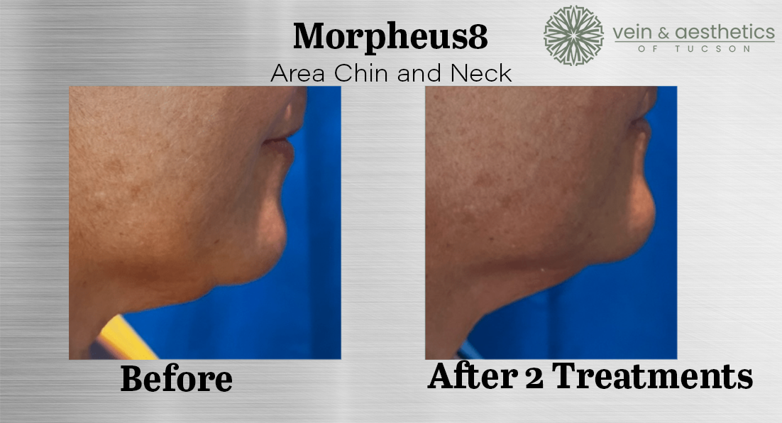chin neck